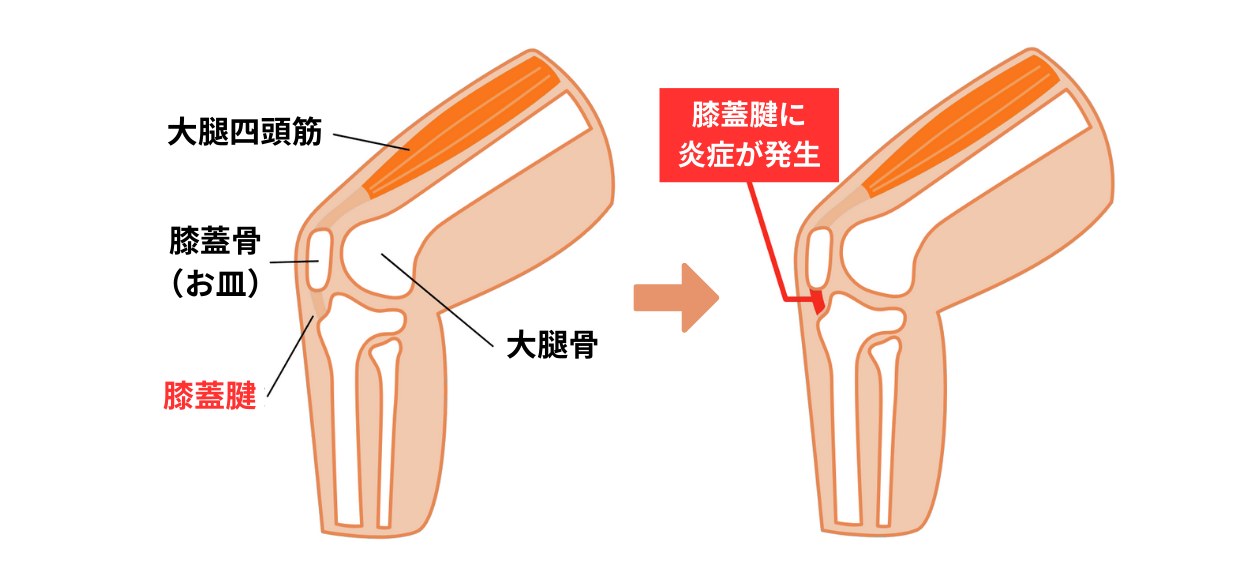 膝蓋腱炎の図解